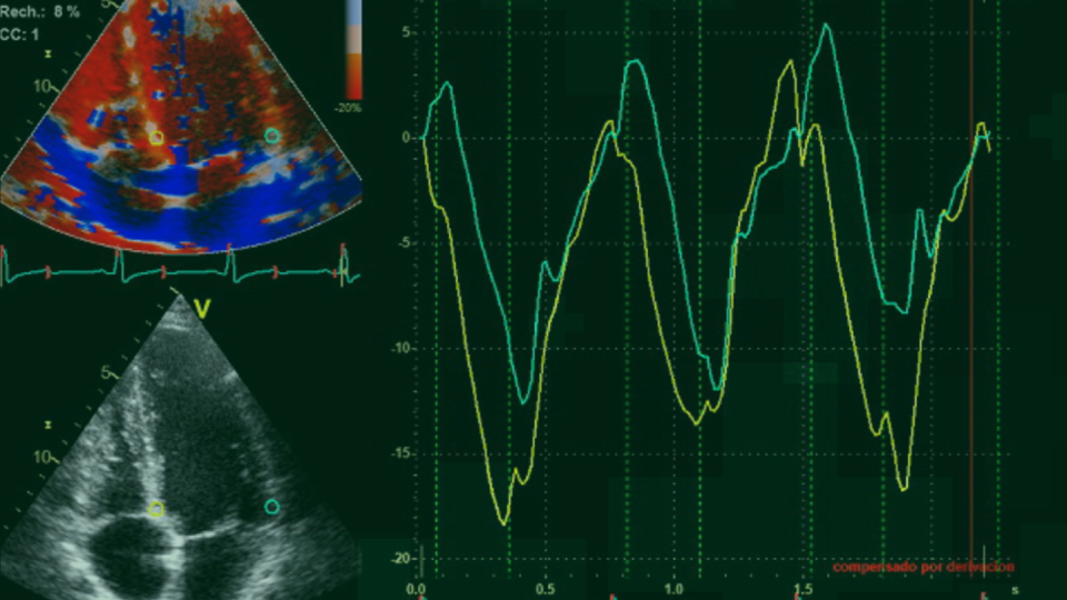 Strain cardiaco